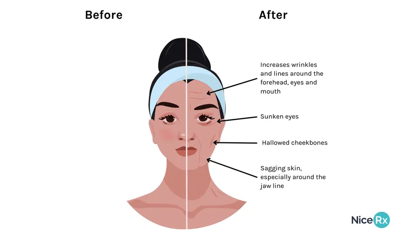 Ozempic face - before and after